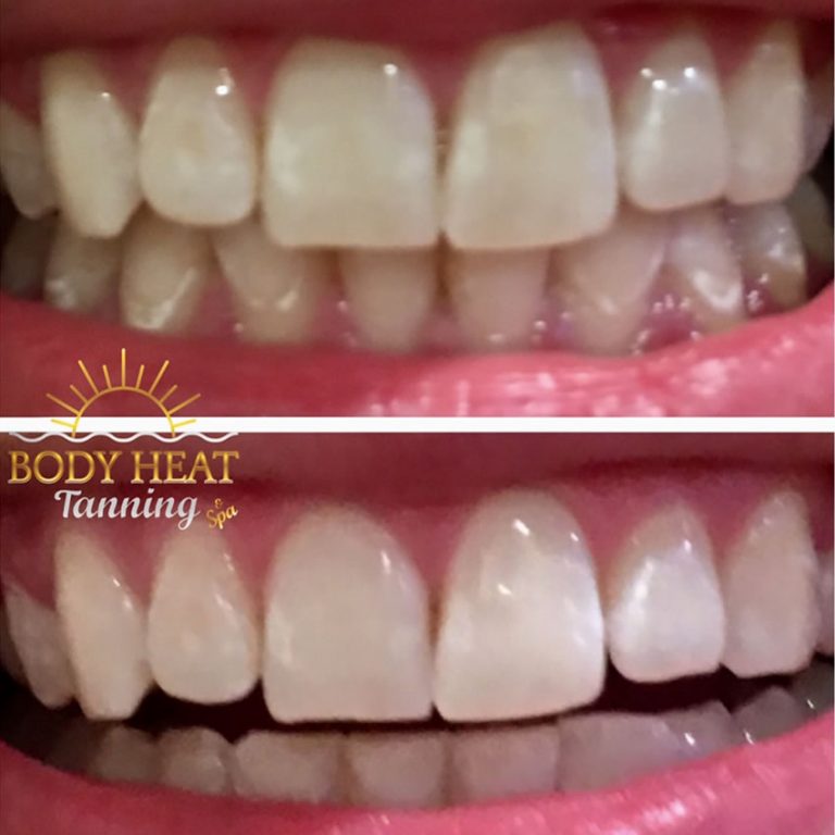 Teeth Whitening Competition Spray Tan Coral Springs